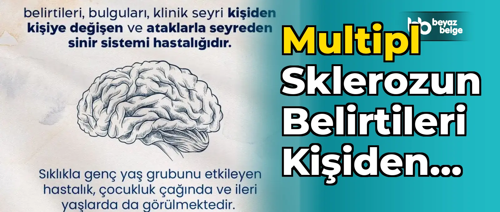 Multipl sklerozun belirtileri kişiden kişiye farklılık gösteriyor